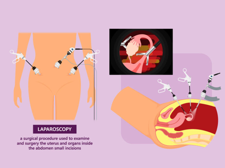 laparoscopy laparoscopy